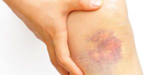 Лазерная операция вен на ногах: в чем преимущества малоинвазивной методики?