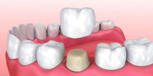 Коронки на зубы: виды, преимущества и стоимость