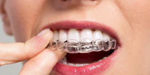 Можно ли выровнять зубы элайнерами