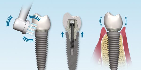 Качественная имплантация зубов с гарантией